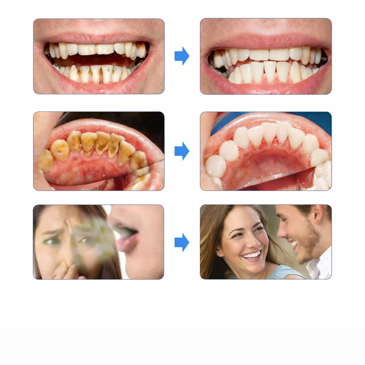 GlowSmile™ – Ultralydrengjøring