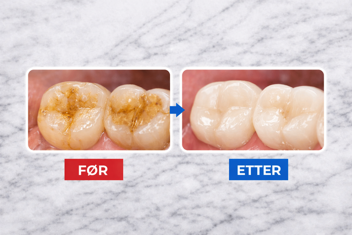 GlowSmile™ – Ultralydrengjøring