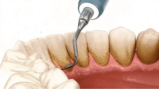 GlowSmile™ – Ultralydrengjøring